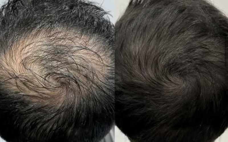 Saç Çoğaltma İşlemi